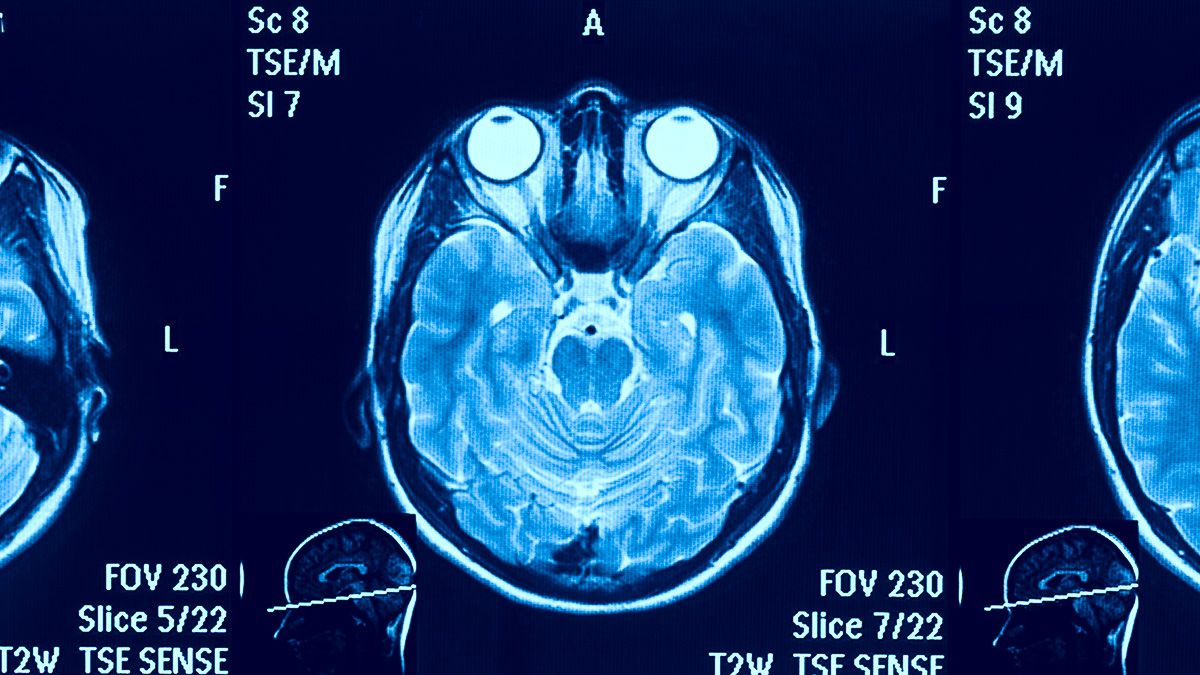 MR-scan av hjärna