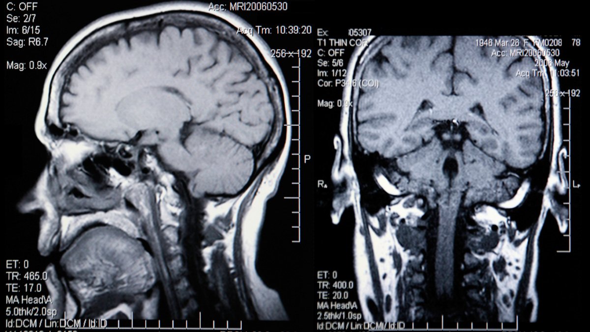 Bilder av hjärna från sidan och bakifrån