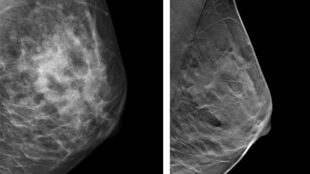 röntgenbild på bröst från mammografi