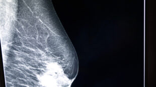 X-ray mammogram