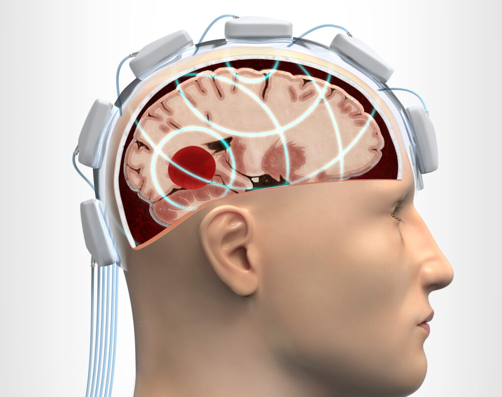 En mikrovågshjälm placeras på patientens huvud och undersöker hjärnvävnaden med hjälp av mikrovågor. Illustration: Boid.