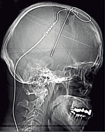 En tunn elektrod placeras djupt inne i hjärnan. Elektroden sänder ut en svag ström som kan minska rörelsestörningarna vid Parkinsons sjukdom. Bild: Patric Blomstedt. 