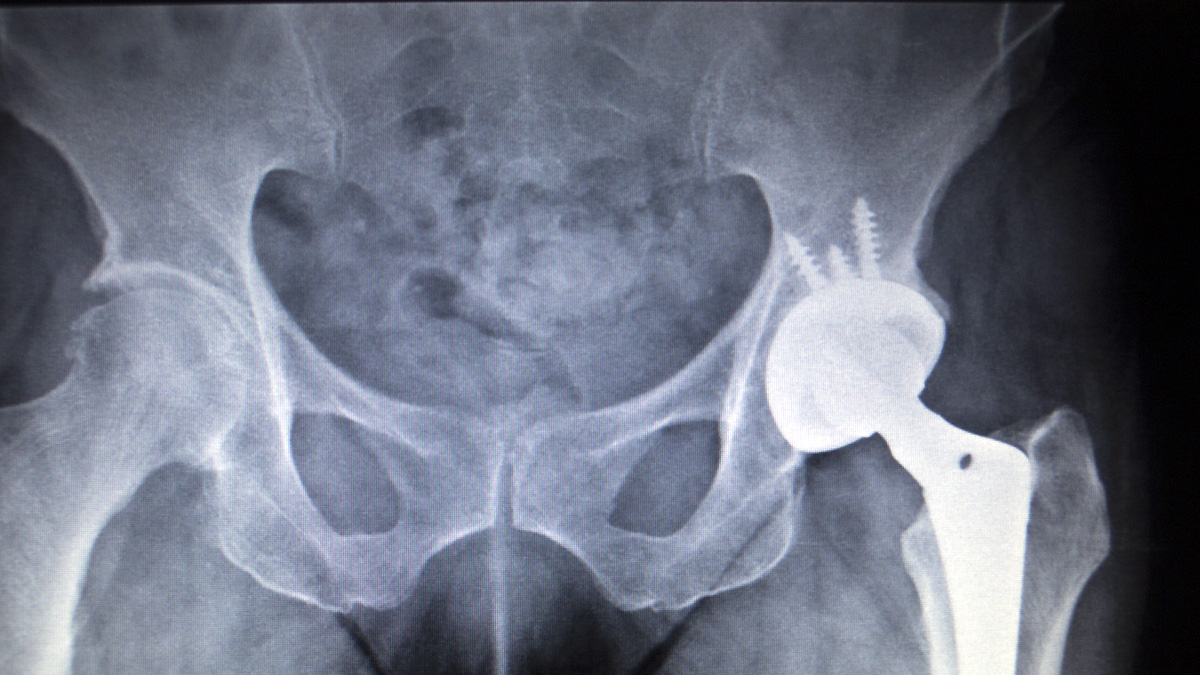 X-ray of hip joint implant