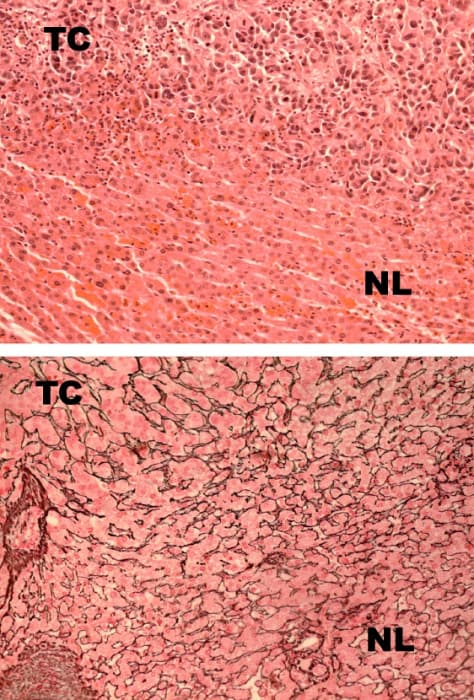 Efter att tumörcellerna (TC) intagit levercellernas (NL) plats, men bevarat arkitekturen och kärlen, går de knappt att urskilja från varandra. I övre bilden syns enbart celler och i den nedre framförallt leverns bevarade arkitektur.