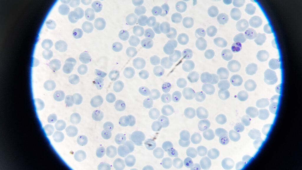 Parasiten syns som en mörk ring i de infekterade röda blodkropparna. Foto: Anna-Karin Landin, Stockholms universitet