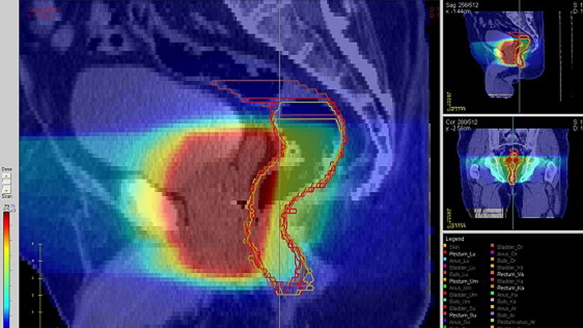 Dosfördelning vid Image Guided Radiotherapy, en metod för preciserad strålning av en prostatacancertumör (Foto: Anders Widmark)