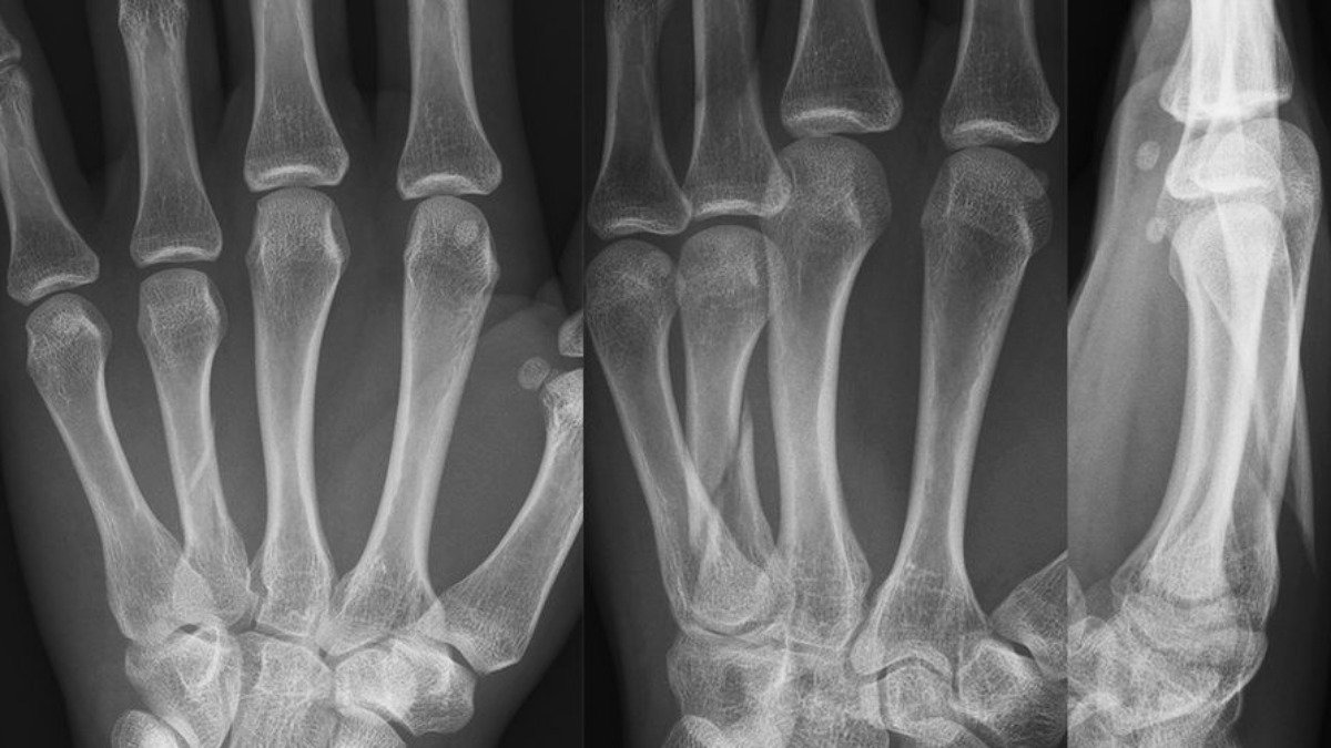 Röntgenbild av tre händer där ett mellanhandsben är brutet.