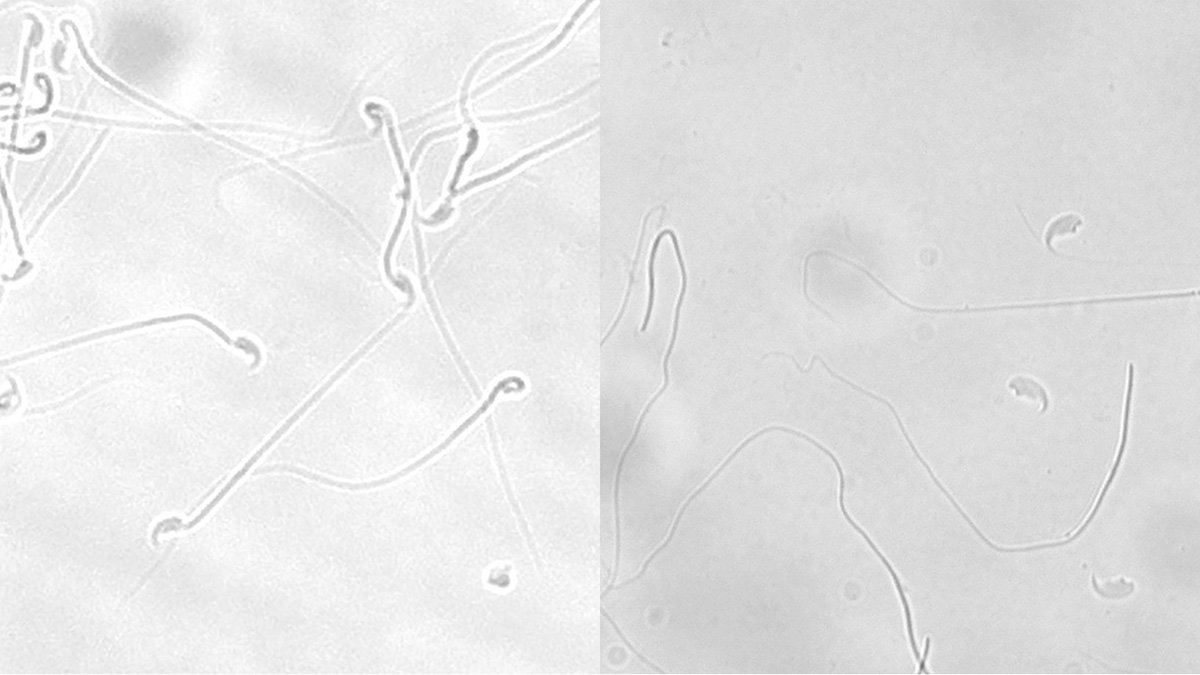 Jämförelse. En bilden visar normala spermier. Den andra visar att spermiernas huvud är separerade från svansen.