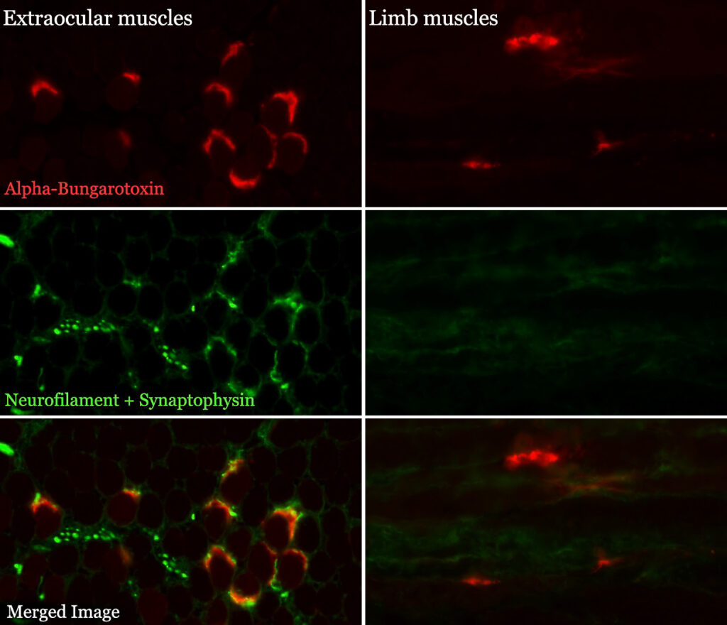 Mikroskopbild av neuromuskulär synapsenen i en ögonmuskel (vänster kolumn) och en benmuskel (höger kolumn) vid ALS. Kontakten mellan nerv (grön) och muskelfiber (röd) är bibehållen i ögonmusklerna (längst ner vänster) medan kontakten bryts och försvinner i benmusklerna (längst ner höger). Foto: Anton Tjust.