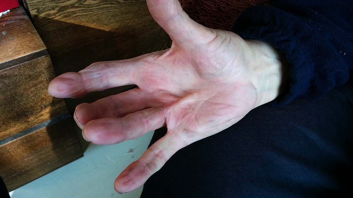 En hand med ett ringfinger som ser spänt och böjt ut.