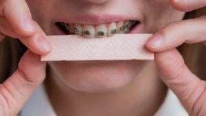 Kvinna med tandställning och ett otuggat tuggummi mellan tänderna.